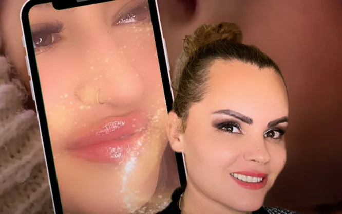 Ilda, grundare av Biofiller Clinic i Göteborg, visar resultat av fillerbehandling