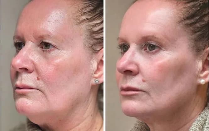 Före och efter fillerbehandling i ansiktet hos Göta Hudklinik Göteborg