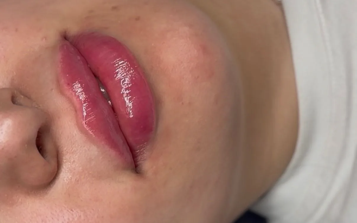 Läppfillers med Stylage hos Léluxe Aesthetics i Malmö