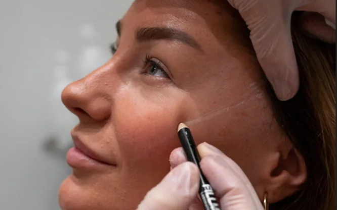 Konsultation och markering inför fillerbehandling hos Lounès Stockholm