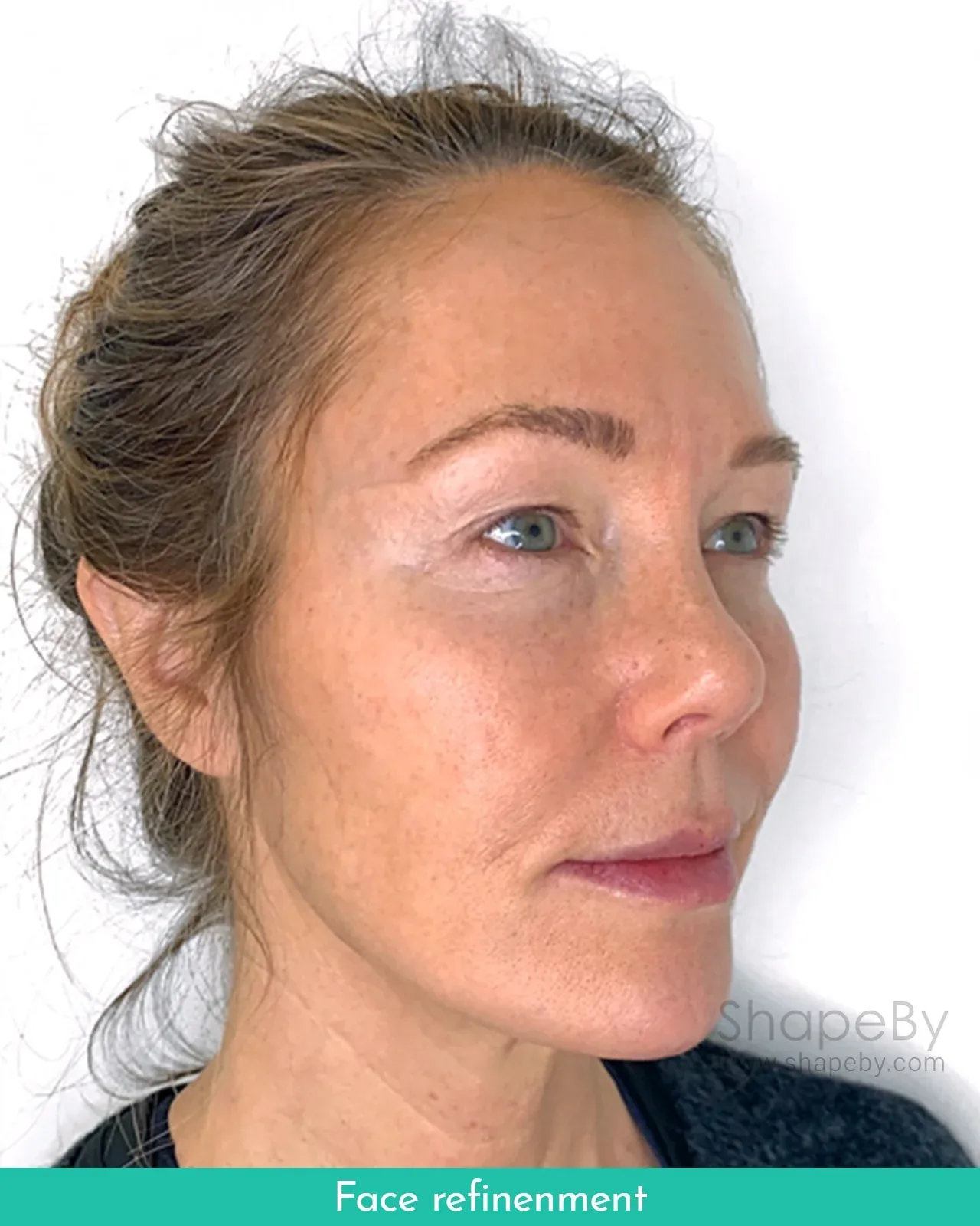Resultat efter face refinement-behandling hos ShapeBy Stockholm